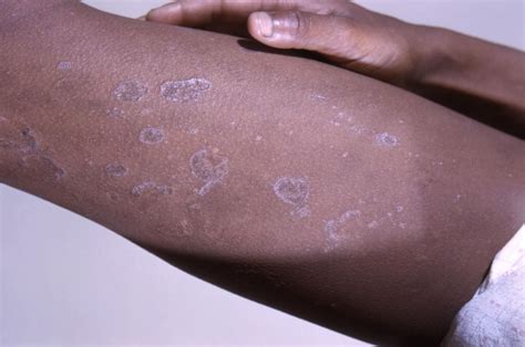 White Flaky Skin On Arms Toxoplasmosis
