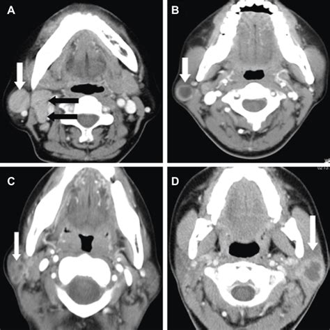 Homogenous Enhancement Notes Tuberculosis Of The Right Parotid Node