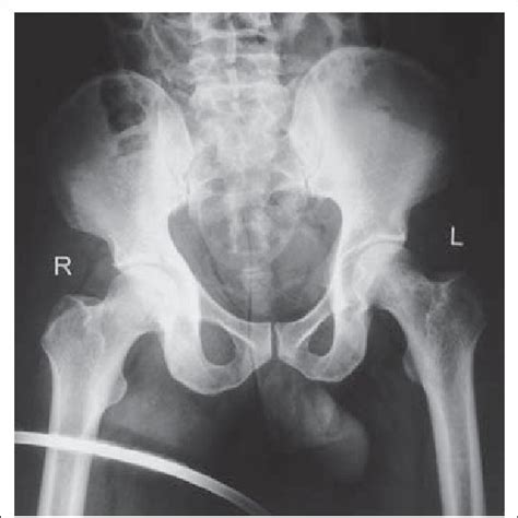 X Ray Showing Anterior Dislocation Of Hip Joint Download Scientific