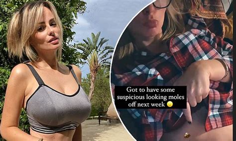Rhian Sugden Reveals She Is Going To Have Some Suspicious Looking Moles Removed Next Week