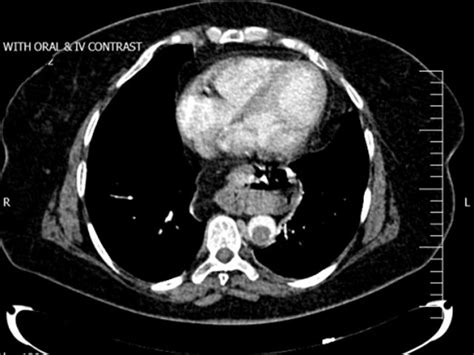 Abdominopelvic Ct Scan With Oral And Iv Contrast Axial View A