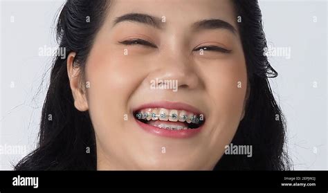 Dental Brace Teen Girl Smiling Looking On A Camera White Teeth With Blue Braces Dental Care