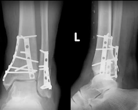 Tibial Pilon Fractures 1 Youtube