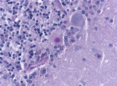 Kuru ist eine äußerst seltene krankheit, die sich vor allem in bewegungsstörungen äußert und nach 12 monaten zum tod führt. Kuru | Dead Island PC Wiki | FANDOM powered by Wikia