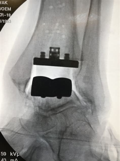 Total Ankle Replacement Arthroplasty Shasta Orthopaedics
