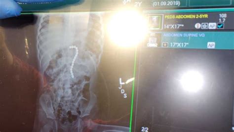 Central Florida 2 Year Old Hospitalized After Swallowing 16 Magnetic Balls