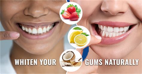 How To Whiten Gums Naturally
