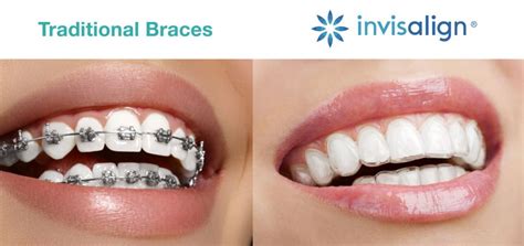 Invisalign And Orthodontics