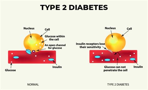 Diabetes is roughly divided into type 1 and type 2. Type 2 Diabetes: Causes, Complications, and Treatments