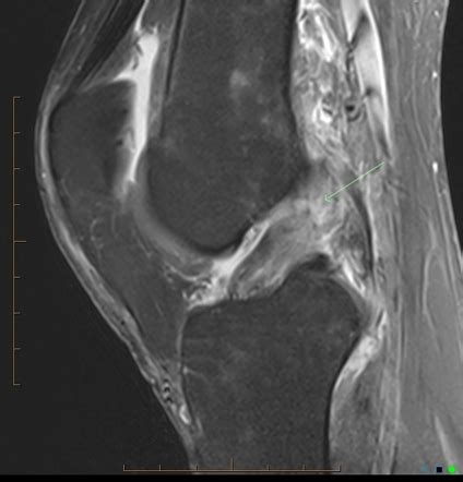 Apparent Spontaneous Healing Of Complete Acl Tear Radiology Case Radiopaedia Org