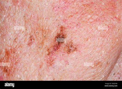 Precancerous Skin Lesion Close Up Of Melanocytic Intraepithelial
