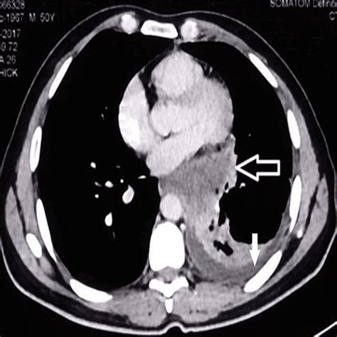Cureus Pulmonary Cryptococcosis Mimicking Lung Cancer A Diagnostic