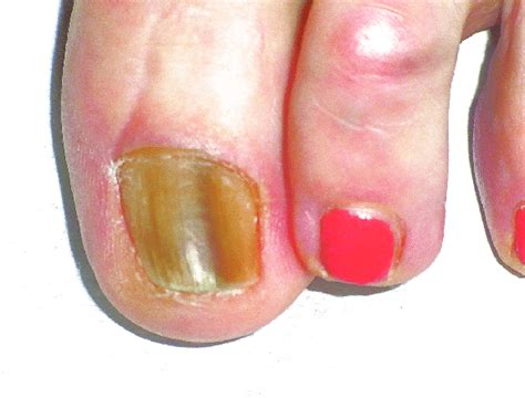 Subungual Melanoma In Situ Of The Big Toe In A 58 Year Old Woman