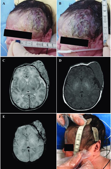 Postnatal Mri And Photographs Showing The Scalp Hemangioma A B