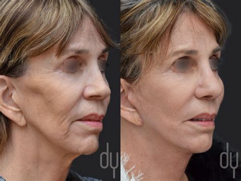 Deep Plane Facelift Before And After Photos