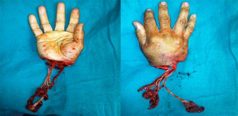 Because that's how gentlemen roll. Hand Replantation