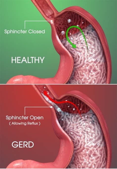 How Many Esophageal Cancer Patients Had Untreated Gerd Scary Symptoms