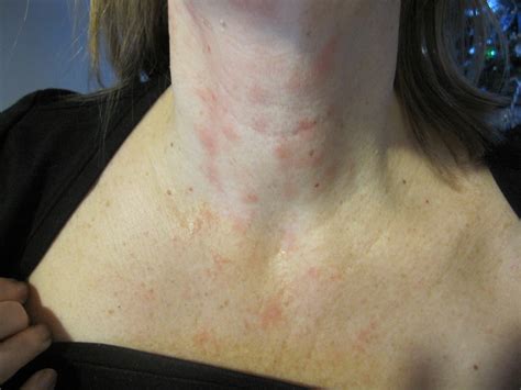 The disease was first described in the 1960s in the new england journal of medicine. red chest and neck - pictures, photos