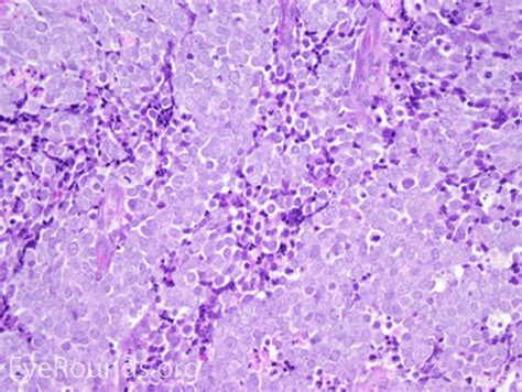 It is a nondendritic, nonkeratinocytic, epithelial clear cell normally found in the epidermis and dermis of mammals and humans. Malignant Lesions of the External Periocular Tissues Tutorial
