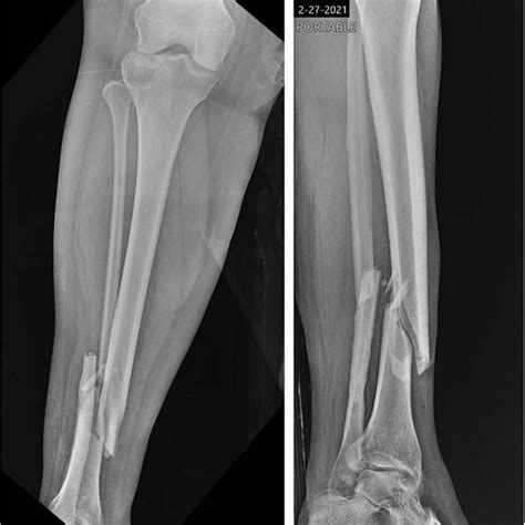Initial Radiographs Demonstrating Fractures Of The Proximal Fibular