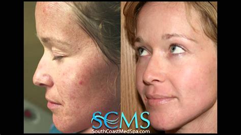 Laser Acne Scar Removal Beforeafter Female Fair Skin