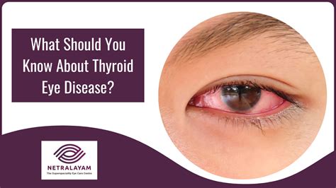 What Should You Know About Thyroid Eye Disease