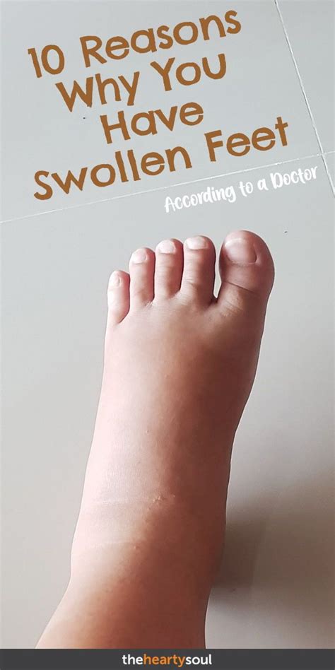 10 Reasons Why You Have Swollen Feet When To See Your Doctor