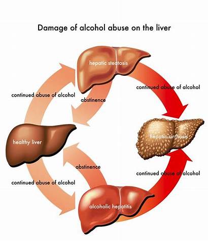 Liver Alcoholic Disease Alcohol Damage Abuse Treatment