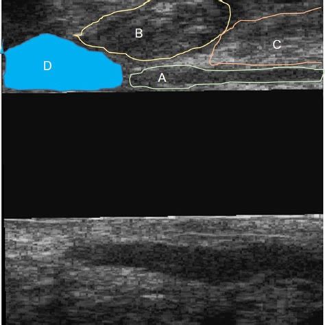 Endoanal Ultrasound Image Showing A Sagittal Section Of An Anterior Download Scientific Diagram