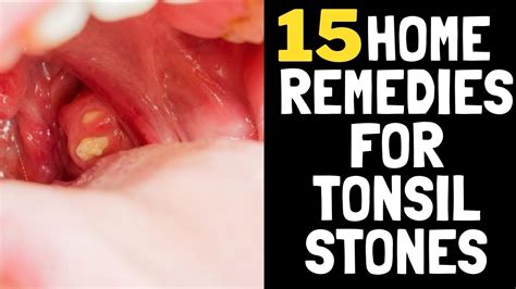 15 Home Remedies For Tonsil Stones Youtube