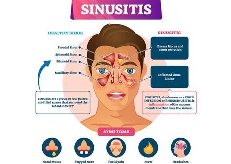 Sinusitis Vs Allergies Sinusitis Chronic Sinusitis Sinus Drainage