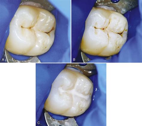 10 Class I Ii And Vi Direct Composite Restorations And Other Tooth