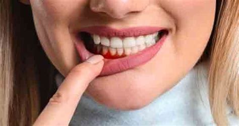 How To Treat Inflamed Gums Naturally How To Do Everything
