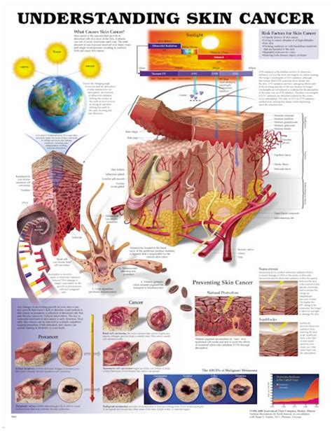 Understanding Skin Cancer Anatomical Chart Physio Needs