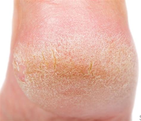 Dry Skin On Feet Causes Symptoms Home Remedies And Treatment Pictures