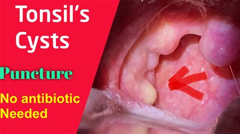 Should I Worry About A Tonsil Cyst Tipseri