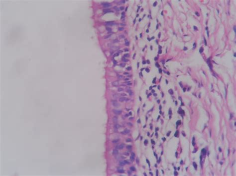 Branchial Cleft Cyst Histopathologyguru