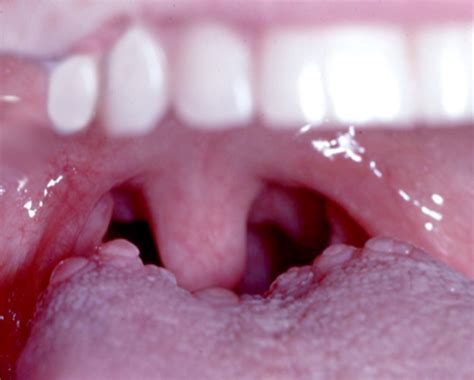 Large Bumps In The Back Of The Tongue Fauquier Ent Blog