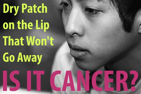 Dry Patch On The Lip That Wont Go Away Is It Lip Cancer Cancer