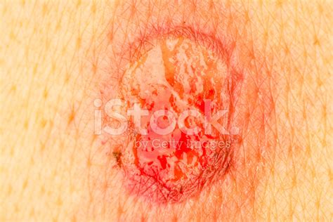 View Of Wound Stock Photo Royalty Free Freeimages