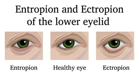 Ectropion Surgery Nashua Entropion Manchester Medical Eye Center