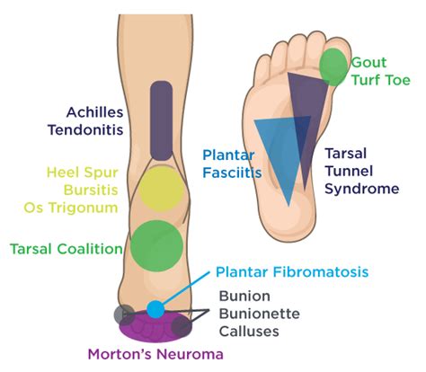 Foot Pain Chart Explained By A Foot Specialist