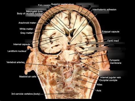 Coronal Cut Brain 66 Diagram Quizlet