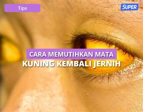 10 Cara Memutihkan Mata Kuning Agar Kembali Jernih And Sehat