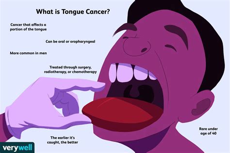 Tongue Cancer Symptoms Causes Diagnosis And Treatment