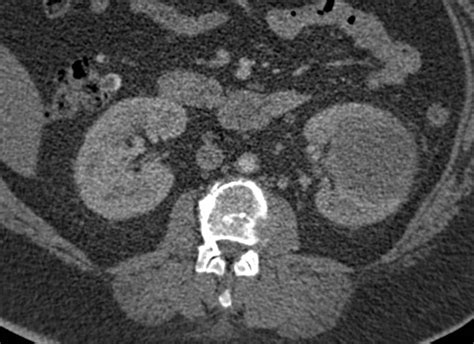 Renal Abscess Simulates A Hypovascular Renal Cell Carcinoma Kidney