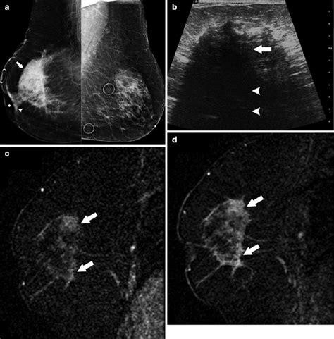 Malignant Breast Tumors Radiology Key