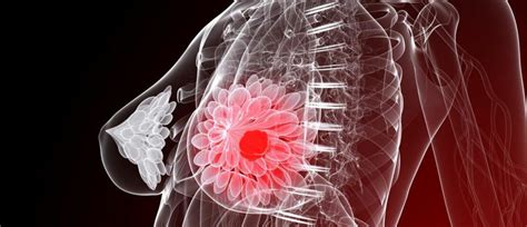 Five Things You Need To Know About Breast Cancer