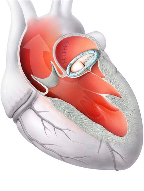 Surgical Reconstruction Of The Mitral Valve Heart Valve Center