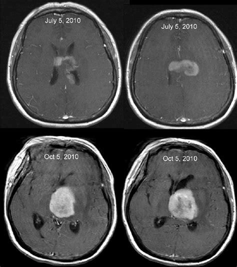 Brain Cns Lymphoma